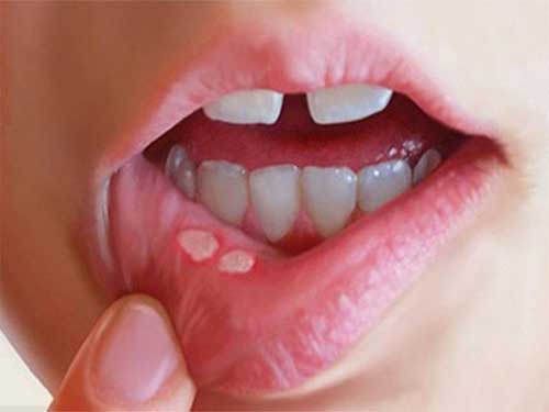 درمان سرطان دهان