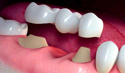 مزایای بریج دندان