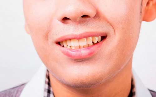 مزایای داشتن دندان های صاف
