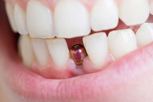 چگونگی انجام ایمپلنت دندان جلو