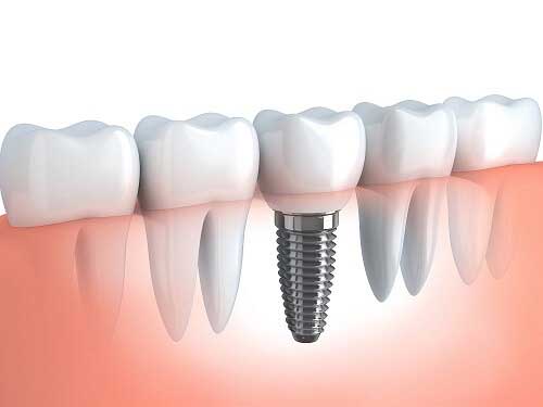 پیوند استخوان دندان چیست؟ هزینه انجام این روش چقدر است