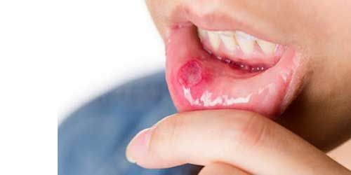 نحوه تشخیص سرطان دهان 