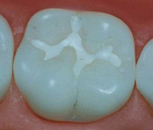 مزایای استفاده از سیلانت دندان