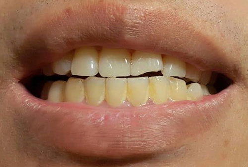 ایجاد پلاک دندان