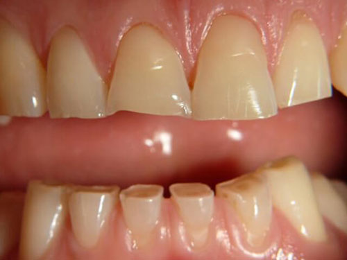علت ساییدگی غیر طبیعی دندان