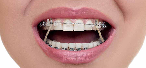 رابطه پوسیدگی دندان و بریس