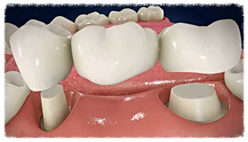 معایب بریج دندان چیست؟