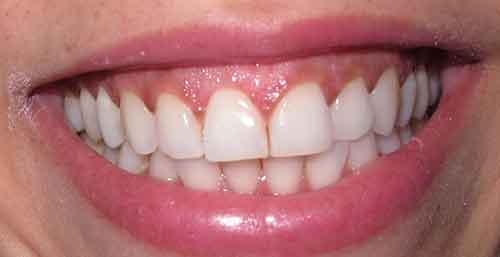پروفیلاکسی دندان