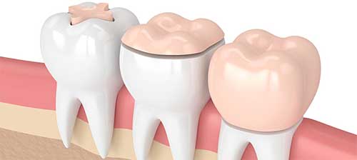 عوارض استفاده از تاج دندان