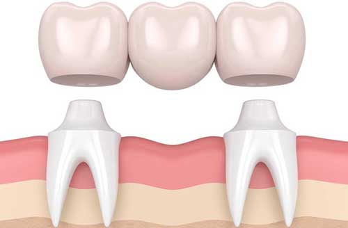 معایب بریج دندان چیست؟