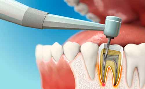 انتخاب دندانپزشک برای درمان ریشه