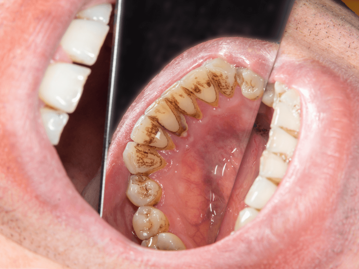 راه های مقابله با رسوبات تارتار بر روی دندان ها