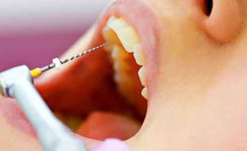انتخاب دندانپزشک برای درمان ریشه