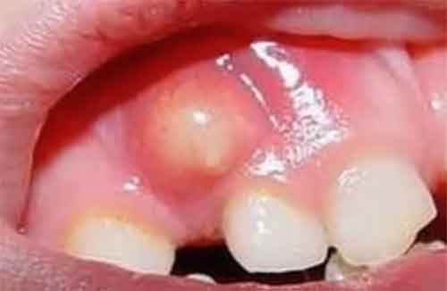 درمان کیست دندان در کودکان