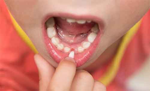 زمان کشیدن دندان در کودکان