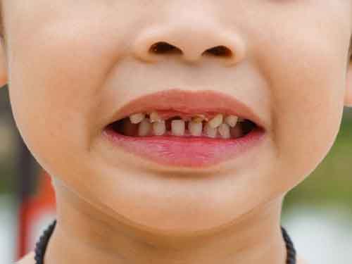 پوسیدگی دندان کودک