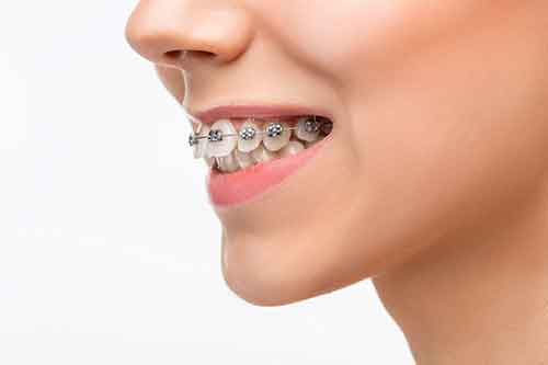 کش دندان در ارتودنسی
