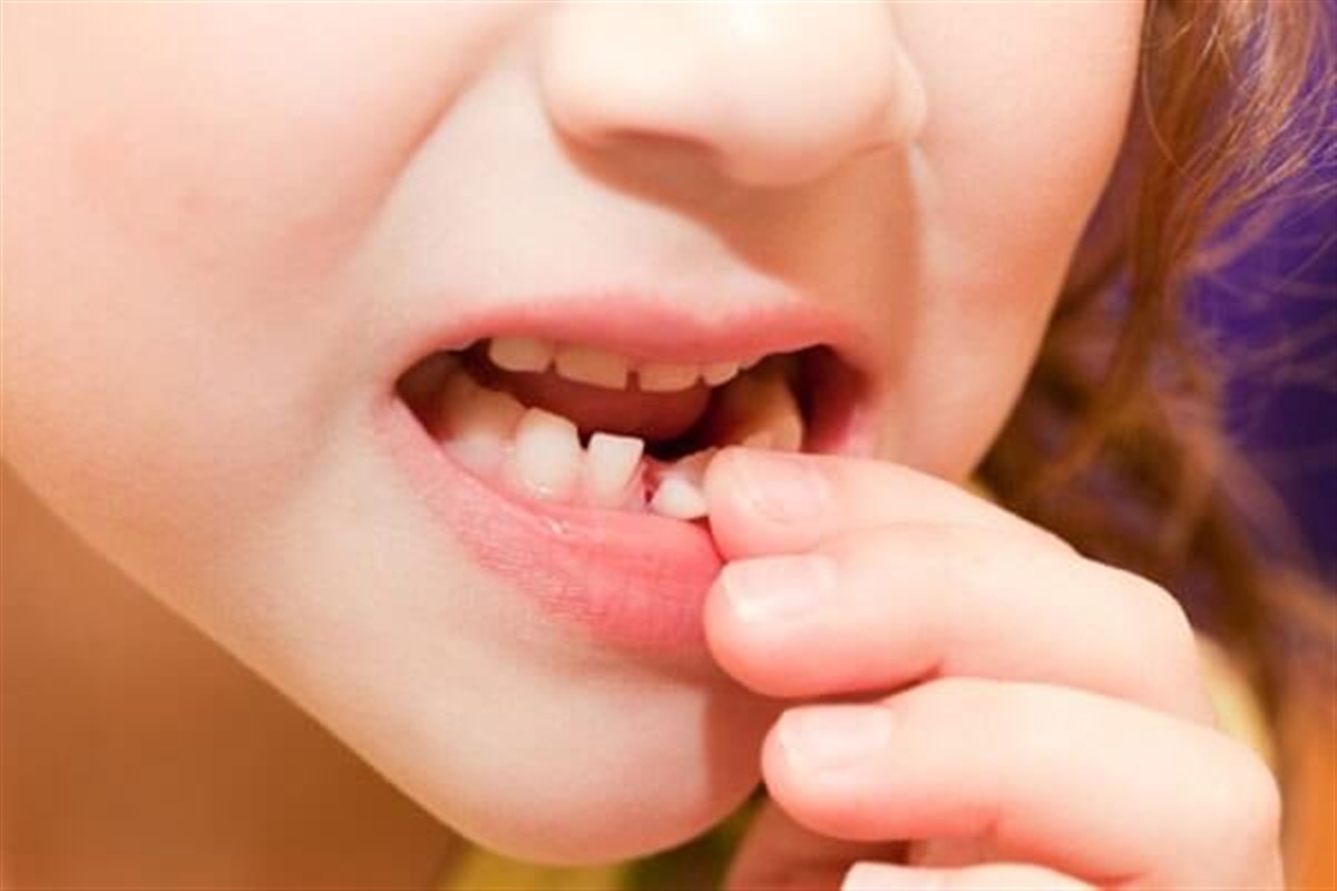 دندان شیری کودکان