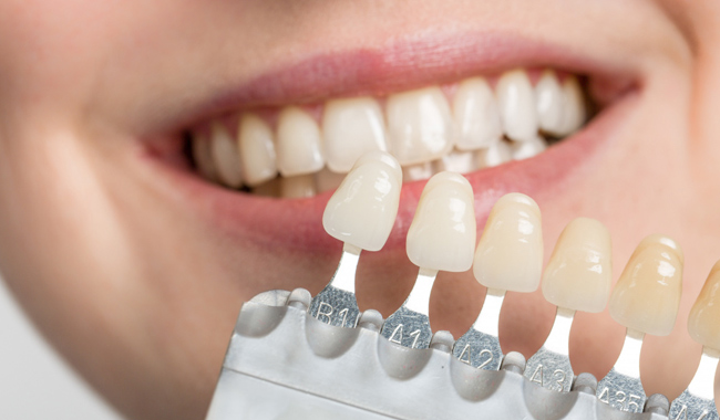 روش های پزشکی سفید کردن دندان