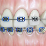عوامل موثر بر هزینه ارتودنسی دندان