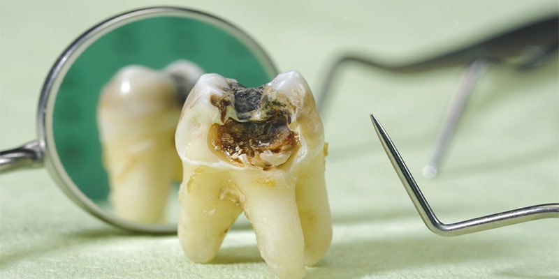 مراحل و انواع مواد پر کردن دندان