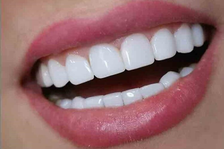 مشاوره رایگان کامپوزیت دندان