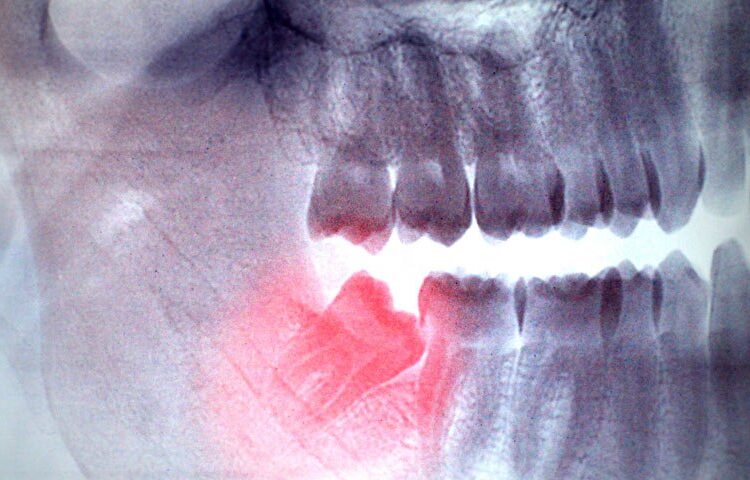 جراحی دندان عقل با لیزر