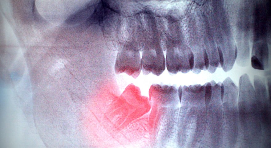جراحی دندان عقل با لیزر