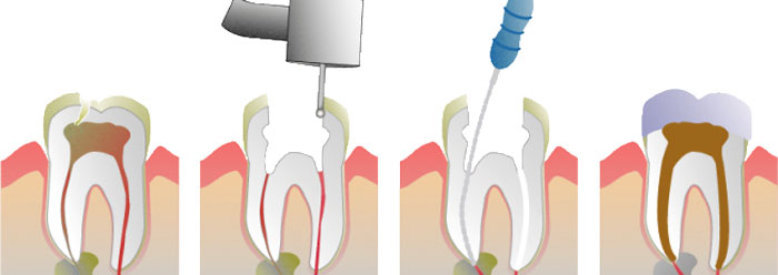 علت درد بعد از عصب کشی دندان