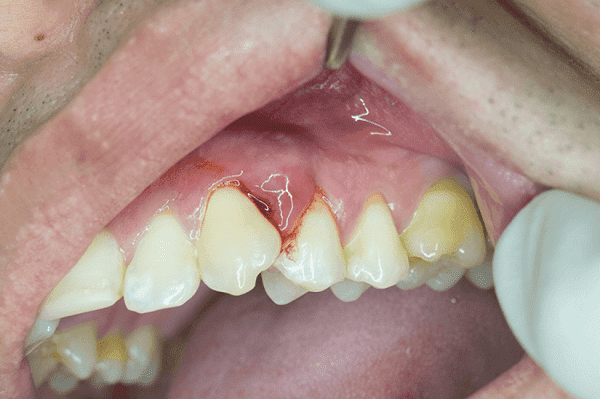 درمان خانگی آبسه دندان