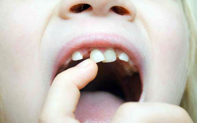 دندان شیری کودک را بکشیم یا پر کنیم