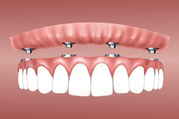 دندان مصنوعی ۴ ایمپلنتی (All on 4)