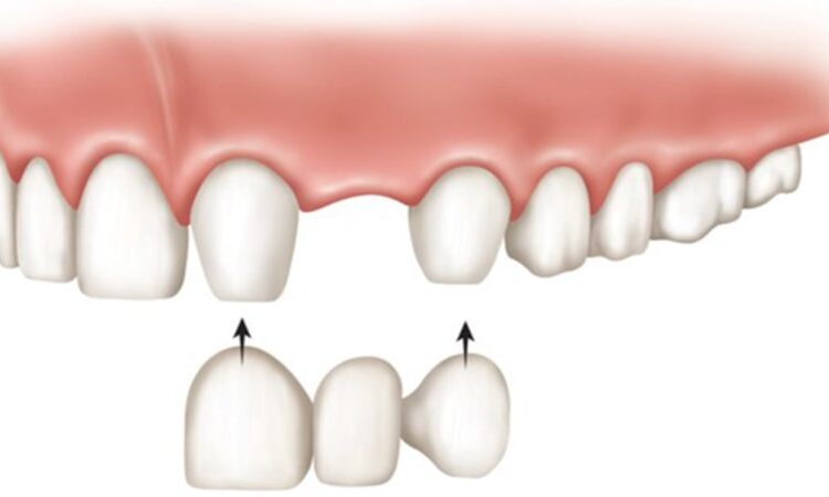 روش های جایگزینی دندان