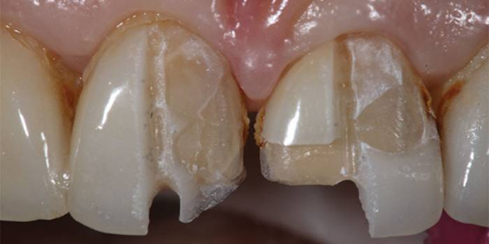 مشکلات احتمالی که ممکن است برای لمینت دندان پیش بیاید!