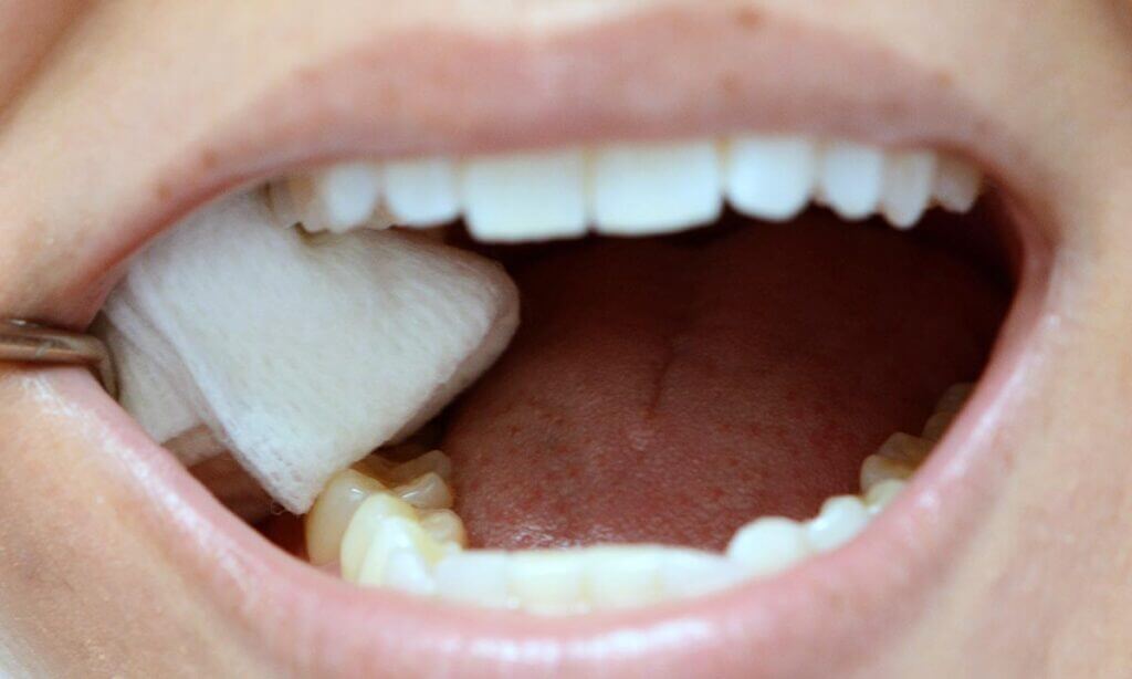 درمان خانگی خونریزی لثه بعد از کشیدن دندان