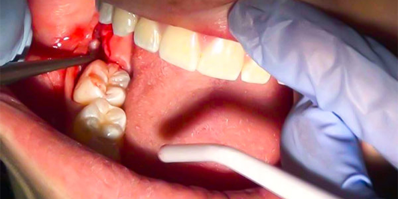 مراقبت بعد از جراحی دندان