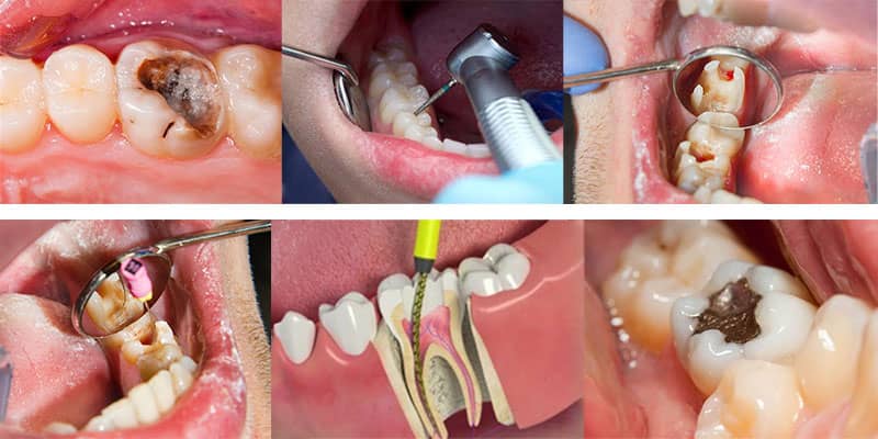 مراحل درمان ریشه دندان نزد متخصص ریشه درمان