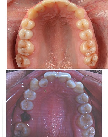 کدام دندان ها ممکن است برای ارتودنسی کشیده شوند؟