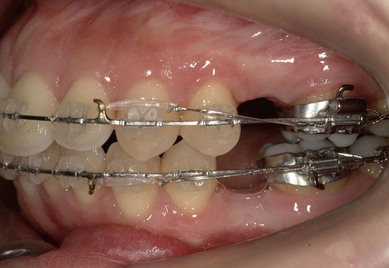 مدت زمان ارتودنسی با کشیدن دندان