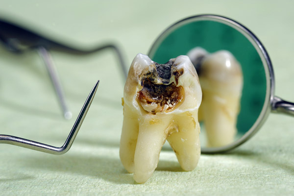 دلایل اصلی خرابی دندان ها