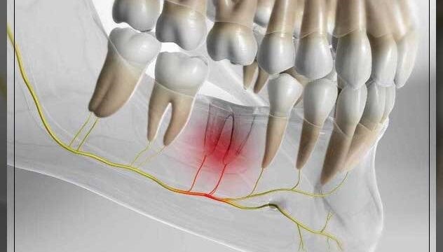  دندان درد عصبی