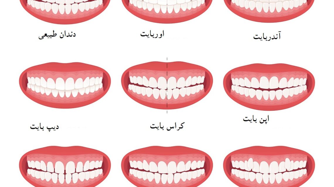 بایت های دندانی مفاهیم اساسی در زمینه ارتودنسی هستند که به نحوه ترازبندی و هماهنگی دندان‌ها و فک‌ها اشاره دارد.