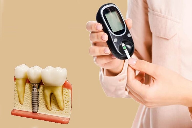 ایمپلنت دندان برای افراد دیابتی