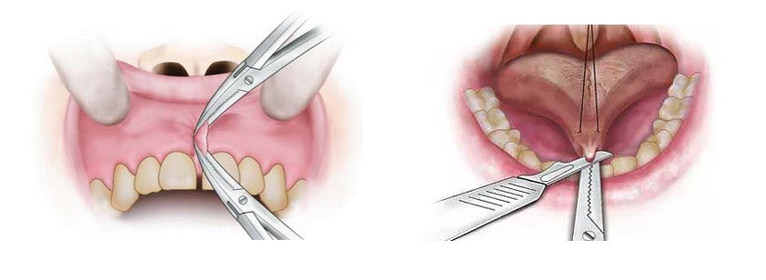 جراحی فرنوم لب بالا و زبان (فرنکتومی: Frenectomy)