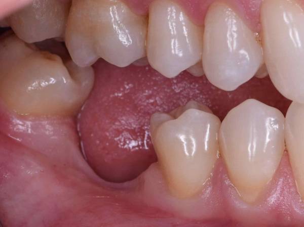 خطرات از دست دادن دندان