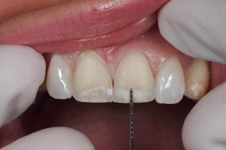 مشکلات بعد از روکش دندان