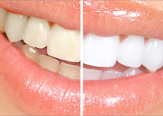 تأثیر سن بر نتایج سفید کردن دندان ها