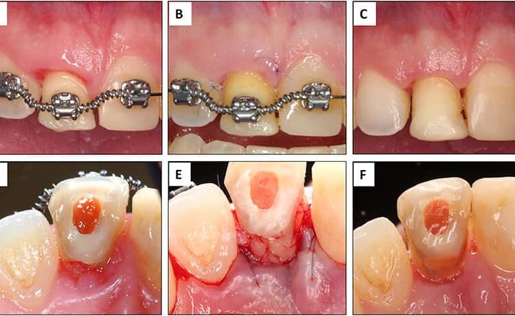 عصب کشی دندان در طول ارتودنسی