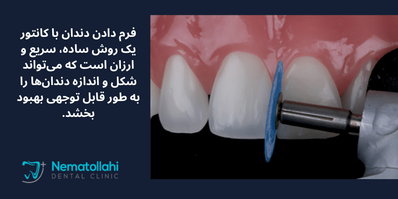 تراشیدن و شکل دادن مینای دندان (فرم دادن دندان با کانتور)