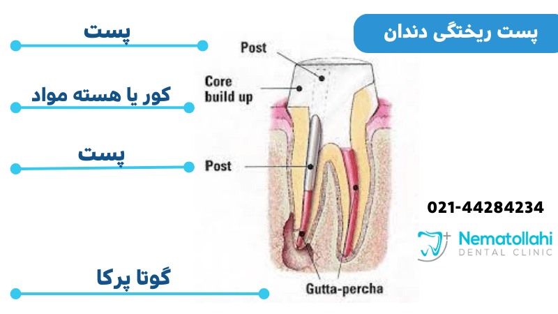 پست ریختگی : روشی برای ترمیم دندان‌های آسیب دیده